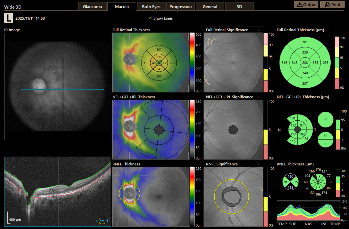 Canon Full Auto Combo OCT Retinal Camera Xephilio OCT-R1 Comprehensive Overview Report