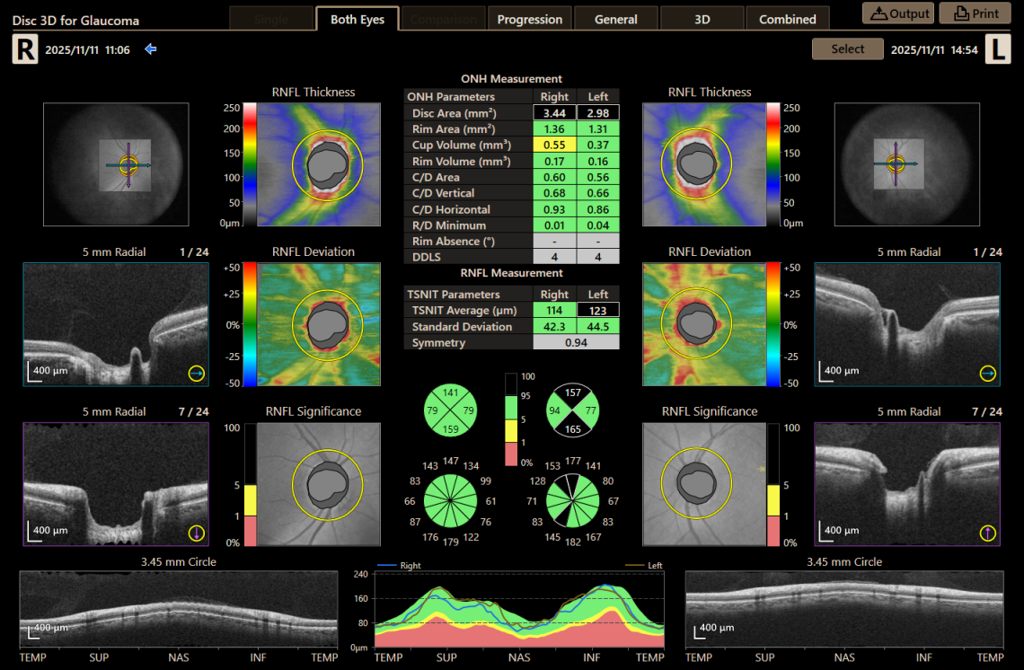 Canon Full Auto Combo OCT Retinal Camera Xephilio OCT-R1 Comprehensive Overview Report