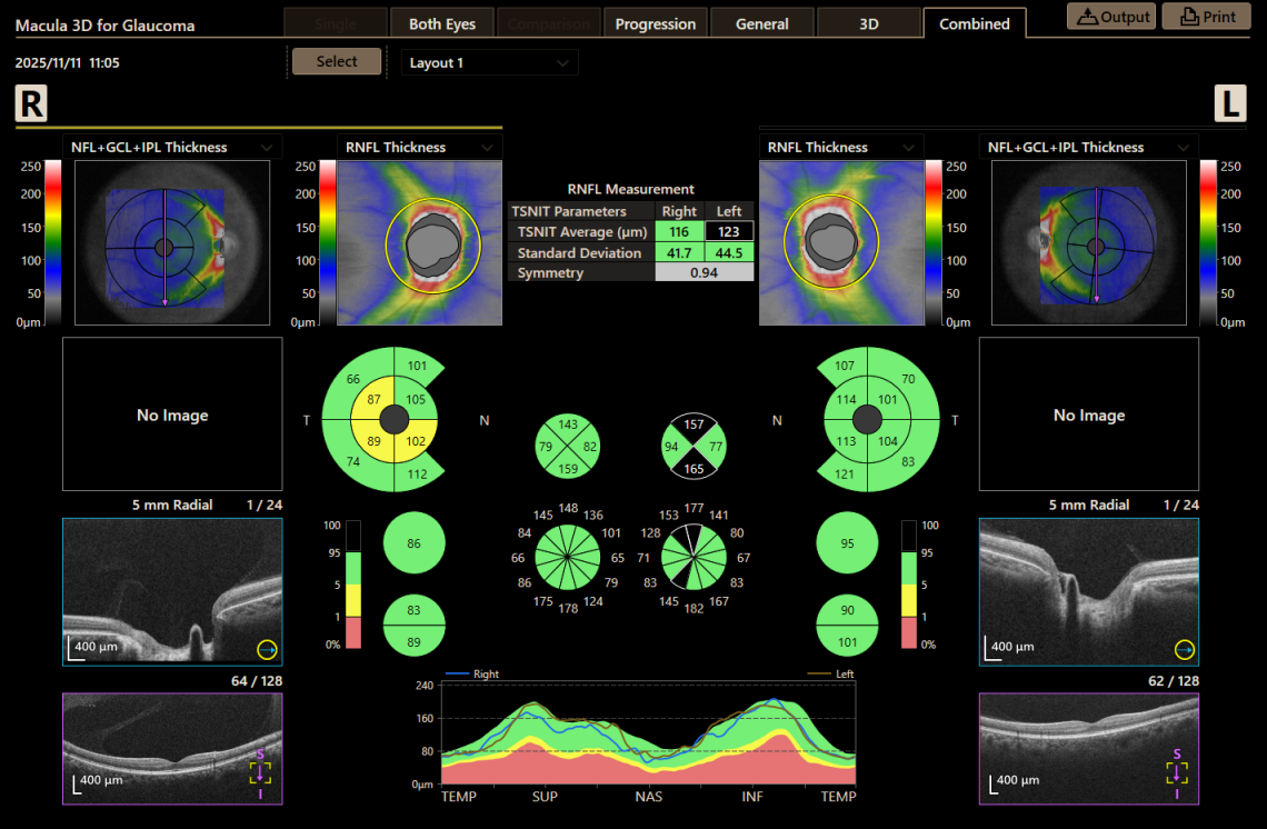 Canon Full Auto Combo OCT Retinal Camera Xephilio OCT-R1 Comprehensive Overview Report