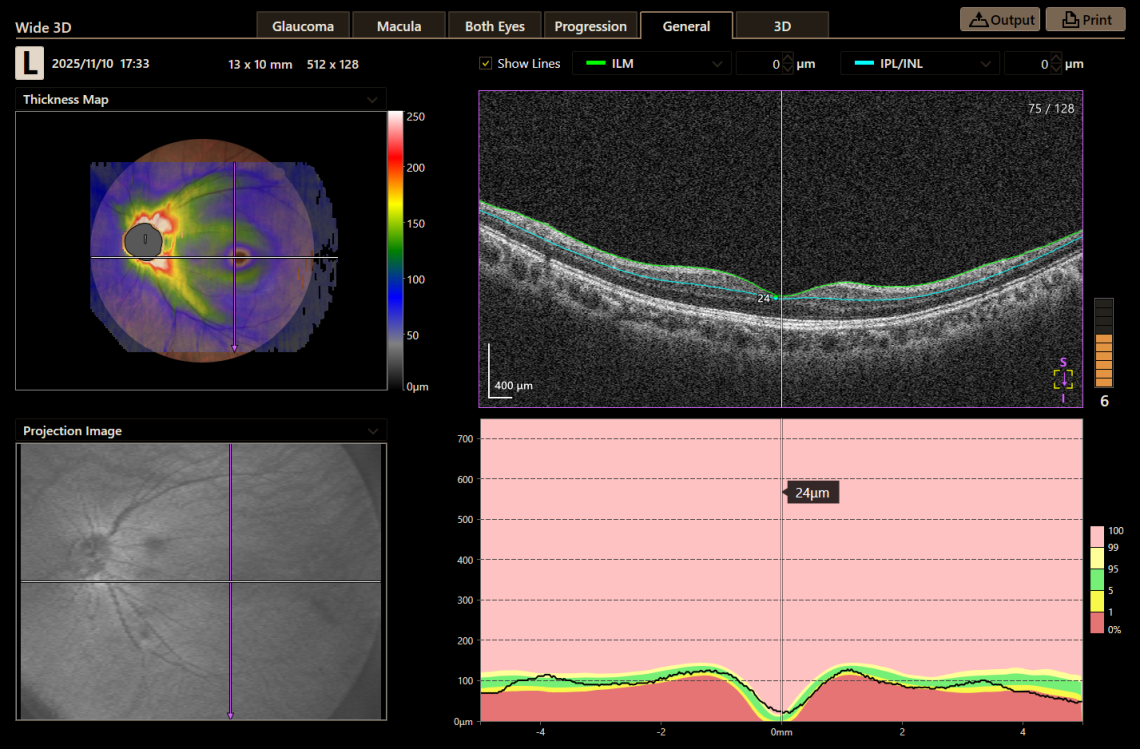 Canon Full Auto Combo OCT Retinal Camera Xephilio OCT-R1 Comprehensive Overview Report