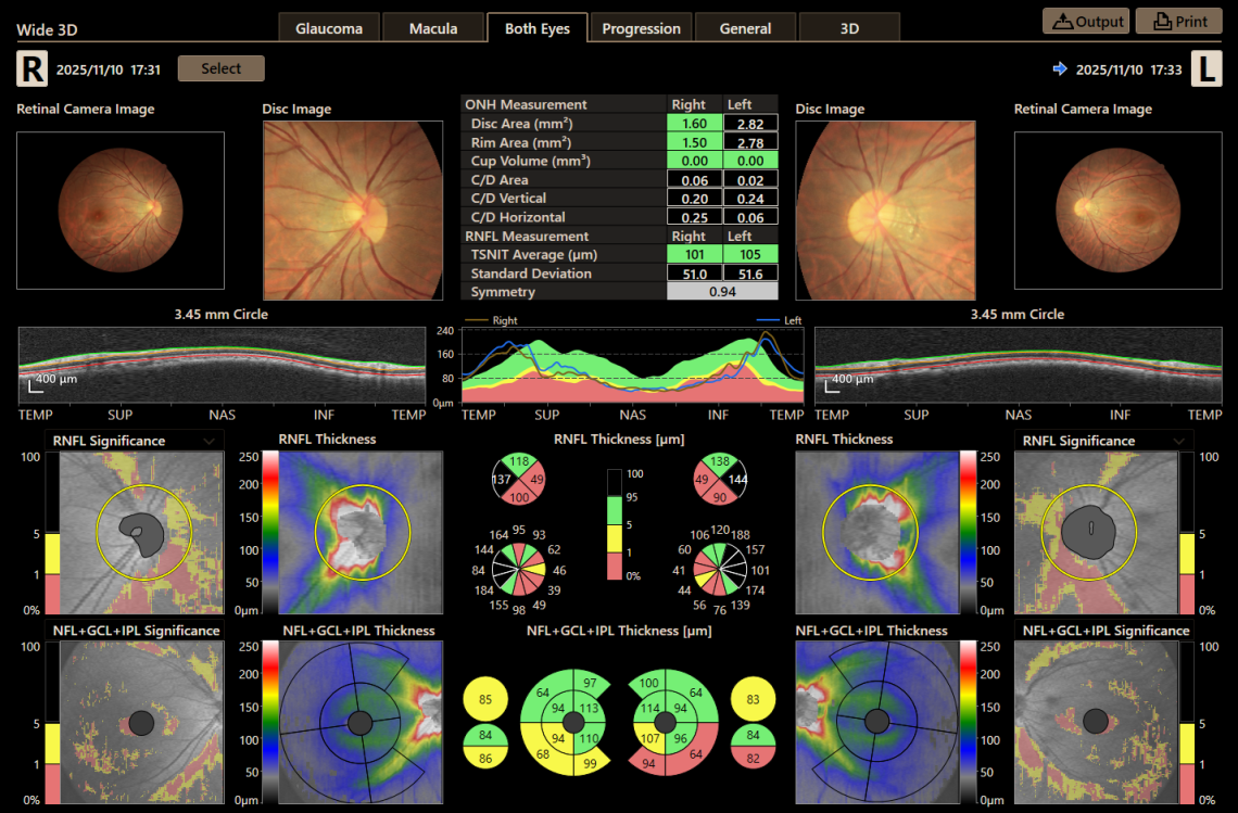 Canon Full Auto Combo OCT Retinal Camera Xephilio OCT-R1 Comprehensive Overview Report
