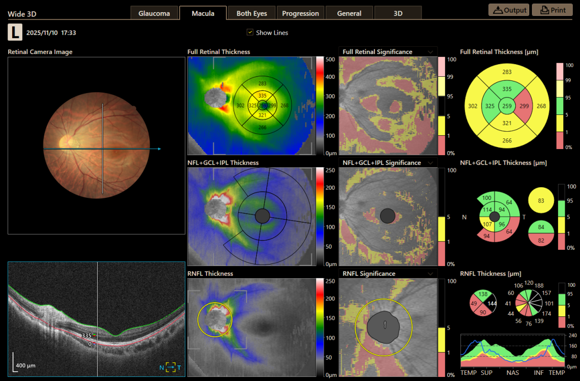 Canon Full Auto Combo OCT Retinal Camera Xephilio OCT-R1 Comprehensive Overview Report
