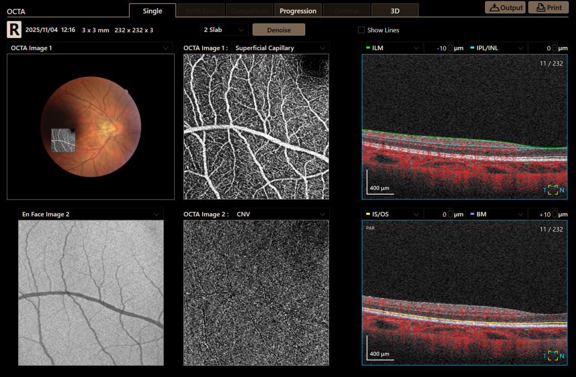 Canon Full Auto Combo OCT Retinal Camera Xephilio OCT-R1 Comprehensive Overview Report