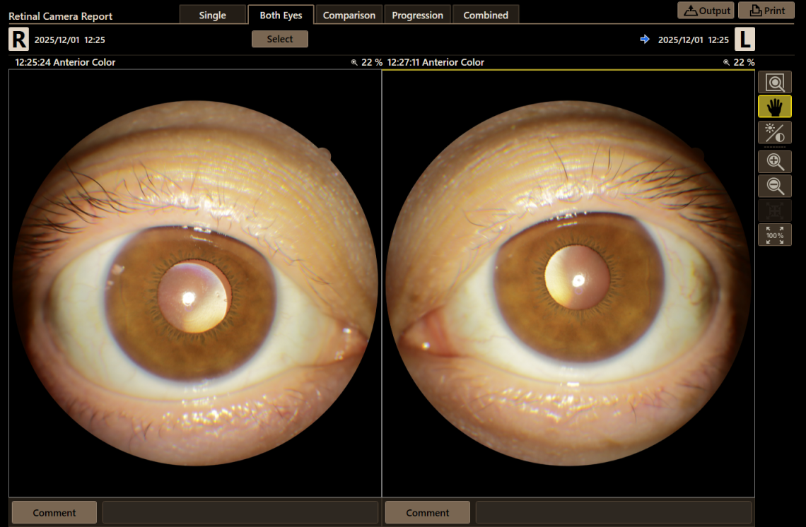 Canon Full Auto Combo OCT Retinal Camera Xephilio OCT-R1 Comprehensive Overview Report